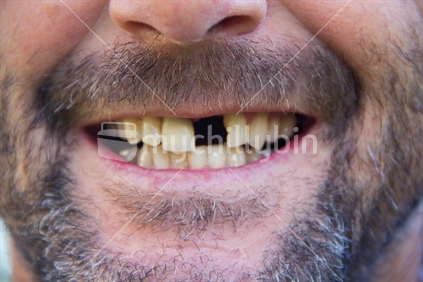 Man smiling, showing a missing front tooth.