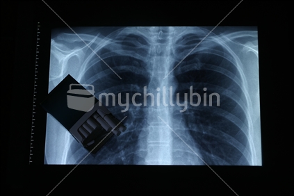 Chest x-ray, & Cigarettes.