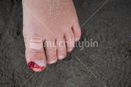 Close up of a stubbed toe at the beach