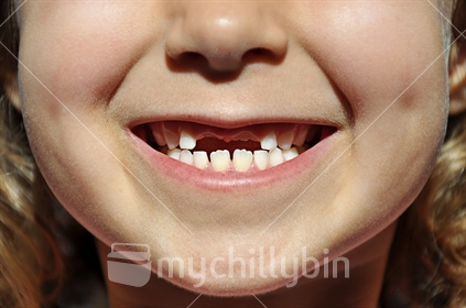 Closeup of smiling young girl missing two front teeth