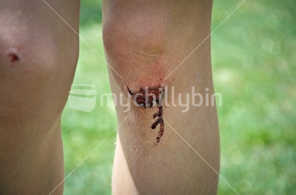 Close up of a freshly injured knee (selective focus)