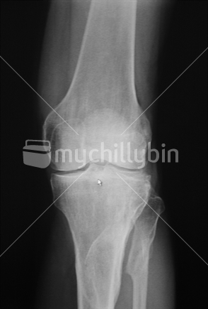 X-Ray of knee joint