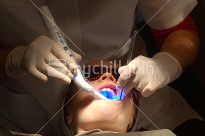 School dental nurse at work on a girl's tooth, curing a filling with UV light. Free dental care is provided for all children in New Zealand. On the West Coast the nurses work in a portable dental surgery.