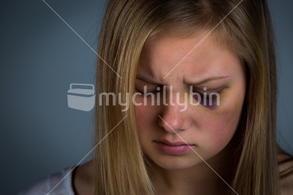 Young teenage girl with black eye and bruising around eye. Available image uses with this image are broader than the regular mychillybin licence terms, specifically permitting use to illustrate domestic violence. Pornographic and defamatory use are still not permitted.