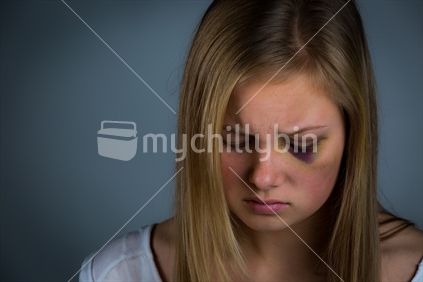 Young Blonde Teenage Girl With Heavy Bruising Sad.  Available image uses with this image are broader than the regular mychillybin licence terms, specifically permitting use to illustrate domestic violence. Pornographic and defamatory use are still not permitted.